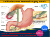 Photo for Laparoscopic Gallbladder Surgery in India