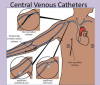 Photo for Global Central Vascular Access Device Market 2018 Forecast to 2023