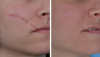Photo for Latin America Scar Treatment Market by Type Of Treatment, Scars and End User: Global Research Report, 2013-2023