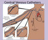 Photo for Global Central Vascular Access Device Market 2018 Forecast to 2023