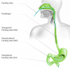 Photo for Global Enteral Feeding Tube Market 2018 Forecast to 2023