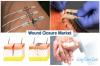 Photo for Wound Closure Market - Global Industry Insights, Size, Share, Trends and Forecast to 2025