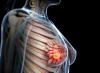Photo for Breast Cancer Diagnostic and Drug Technologies Market - Industry Global Growth, Production, Revenue, Demand & Applications 2018-2025