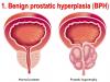Photo for Benign Prostatic Hyperplasia (BPH) Procedures Market Analysis By Growth and Demand