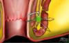 Photo for Internal Piles Treatment  Ayurveda Nagpu