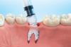 Photo for Tooth Regeneration Market has an Estimated Addressable Potential of US$ 6.2 Billion by 2024