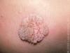 Photo for Folsom Laser Wart and Mole Removal Hand Feet Genital and Plantar Warts