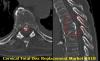 Photo for Cervical Total Disc Replacement Device Market to increase rapidly by 2023