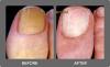 Photo for Laser Nail Fungus Clinic San Diego La Jolla Carlsbad