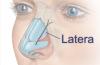 Photo for Absorbable Nasal Implants Market- Segmented by Mode of Workflow, Components, Mode of Delivery and Geography - Growth, Trends, and Forecast (2018 - 2025)