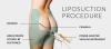 Photo for Liposuction Treatment/Surgery in Delhi