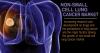 Photo for Non-Small Cell Lung Cancer Market Growth, Size, Share, Analysis, Trends and Forecasts To 2024