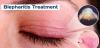 Photo for Blepharitis Treatment Market - Size, Share, Trends, Outlook, and Analysis, 2018-2026