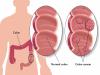 Photo for Malignant Ascites Treatment Market Size, Share, and Outlook 2026
