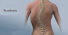 Photo for Scoliosis Management Market Global Outlook 2026