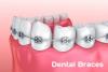 Photo for Dental Braces Market - Industry Insights, Size, Share, Growth, Analysis, Trends and Forecasts To 2026