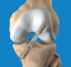 Photo for Bioabsorbable Bone Screw Market - Size, Share, Outlook, and Forecast till 2026