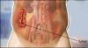 Photo for Retroperitoneal Liposarcoma Treatment Market Share, Outlook 2026