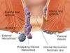 Photo for Advanced laser treatment for piles and fistula in Mumbai