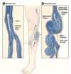 Photo for Varicose Veins Laser Treatment in Mumbai