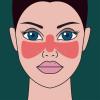 Photo for Systemic Lupus Erythematosus Treatment Market Opportunity Analysis 2018-2026