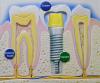Photo for Is your tooth missing? Dental implant is the best option