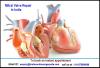 Photo for Cost of Mitral Valve Repair in India