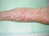 Photo for Thrombocytopenia Treatment Market - Opportunity Analysis, 2018-2026