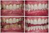 Photo for Get 10% Discount on Full Mouth Rehabilitation