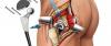 Photo for Hip Replacement Surgery Cost In Mumbai
