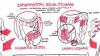 Photo for Global Inflammatory Bowel Disease Market Research Report 2018 - 2022