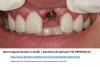 Photo for Get Single Tooth Implant at Best Dental Clinic in Delhi