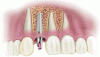 Photo for Smile with Confidence by Dental implant in Delhi