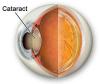 Photo for Cataract Surgery Devices Market Opportunity Analysis, 2018-2026