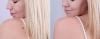 Photo for Skin Mole Removal Edmonton