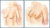 Photo for BREAST LIFTING SURGERY