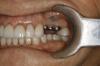Photo for Say Goodbye to Cavity | Best Dental Clinic in Delhi