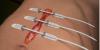 Photo for Wound Closure Device Market 2018 to Witness Excellent Long-Term Growth Outlook
