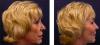 Photo for Minimal Incision Facelift | Minimal Incision Surgery | Mini Facelift Chicago
