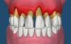 Photo for Periodontal Disease Therapeutics Market Opportunity Analysis 2018 - 2026
