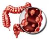 Photo for Colon and Rectal Cancer Drugs Market Opportunity Analysis, 2018 – 2026