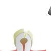 Photo for Root Canal Treatment