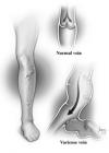 Photo for Varicose Vein and Spider Vein Treatment Options | SPIDER VEINS