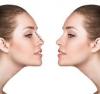 Photo for Best Nose Job, Rhinoplasty Surgery In India