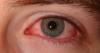 Photo for The Dry Eye Syndrome Market World Leading Key Players Revenue, Share, Analysis and Estimation Till 2023