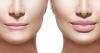 Photo for Lip Filler