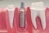 Photo for Tooth Implant