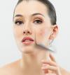 Photo for Best Treatment for Acne Scars