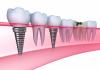 Photo for Dental Implants