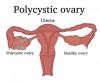 Photo for Polycystic Ovary Syndrome Market Innovative Treatments, Key Methodologies, Top Players Success Milestones and Forecasts to 2023